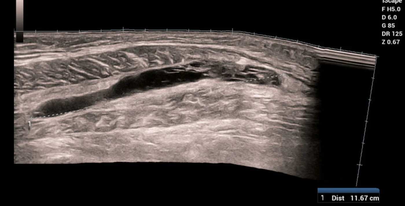 Ultrasound image showing calf muscle bleed