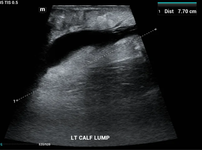 Ultrasound image showing morel-lavallee lesion